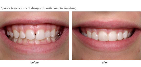What is the best way to bond composite resin to tooth enamel? - Quora